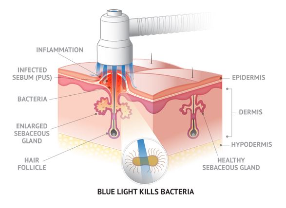 Acne Facial Blue Light