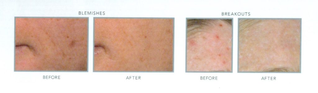 Acne Facial with Blue Light Before & After