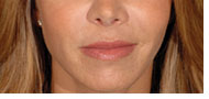 Juvederm and Restylane NYC
