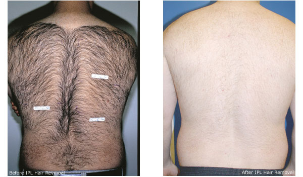 Before and after photos for intense pulsed light hair removal showing a male patient