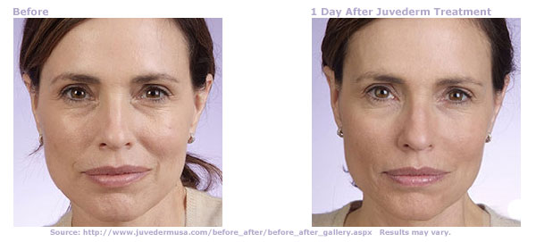 A woman before and after Juvederm NYC treatment for wrinkles around the mouth (nasolabial folds)