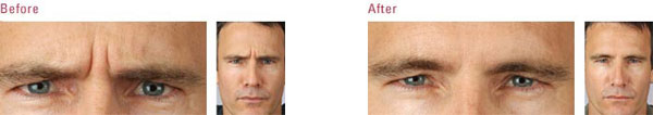 A man before and after New York Botox treatment between the eyebrows (glabella).