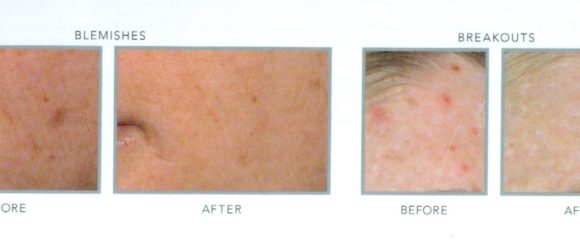 Acne Facial with Blue Light Before & After
